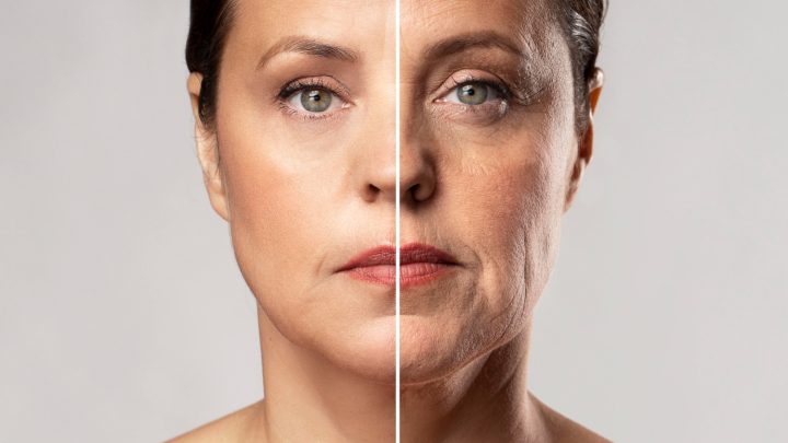 botox ou preenchimento