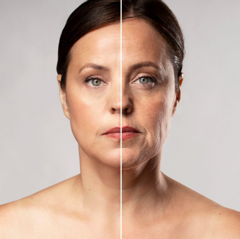 botox ou preenchimento